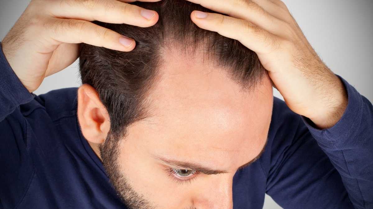 5 Reasons Why Hair Transplant Fails