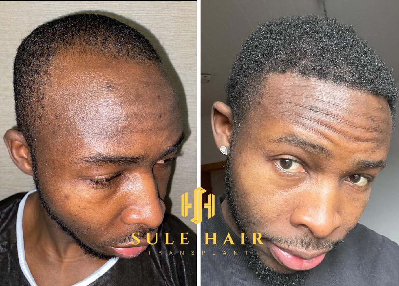 afro hair transplant result
