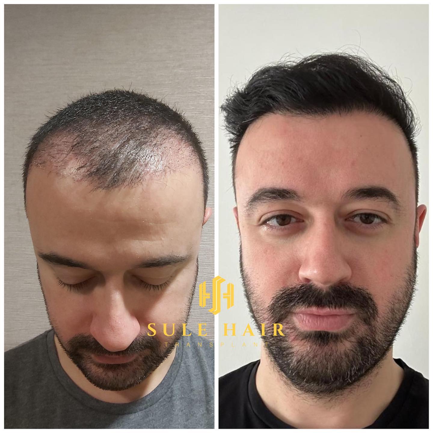 Hair Transplant Turkey Before And After Photos Sule Clinic