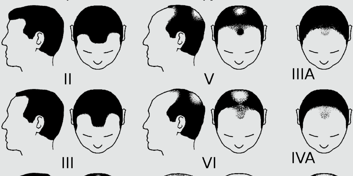 Understanding Hair Loss with Norwood Scale